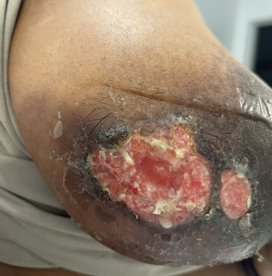 Skin starting to heal a bit after drainage.